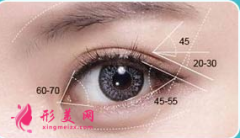 开眼角术后护理需要注意什么？