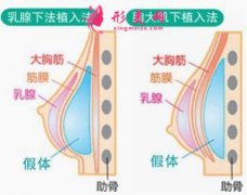 假体隆胸术适合哪些人群？