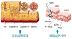 吸脂减肥过程痛不痛