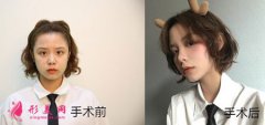 北京圣嘉新医疗美容医院做面部吸脂如何？我也可以拥有小V脸