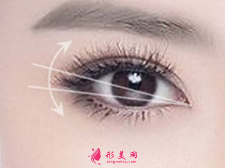 开眼角术后饮食方面有什么需要注意的吗