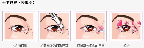 开眼角过程.jpg