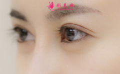 双眼皮手术痛不痛呢？