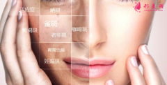激光祛斑后有红肿怎么办？