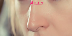 自体软骨隆鼻术后会钙化吗？