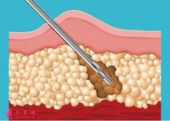 腰腹部吸脂术后护理要注意什么？