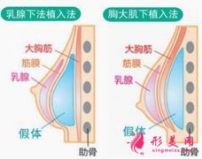 假体隆胸对身体有什么危害吗?