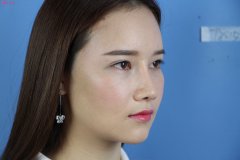 玻尿酸填充脸部的优势有哪些？