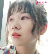 自体软骨隆鼻术后遗症有哪些？注意事项要做好