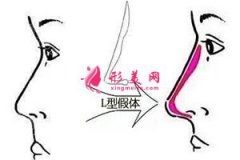 自体软骨隆鼻，是不是比假体隆鼻更好？