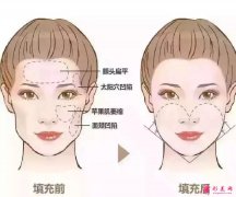 脂肪填充面部半年后会下垂是真的吗？