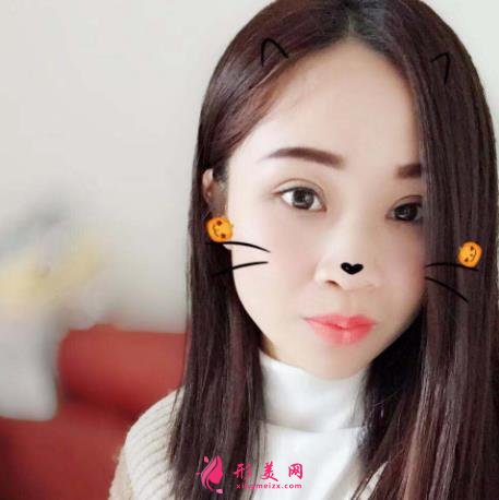 深圳北大医院整形科做双眼皮怎么样？案例及价格表（多少钱）在线参考