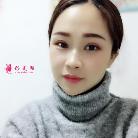 深圳北大医院整形科做双眼皮怎么样？案例及价格表（多少钱）在线参考