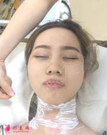 东营整形医院哪家好？排名前三口碑机构盘点_含除皱恢复效果图