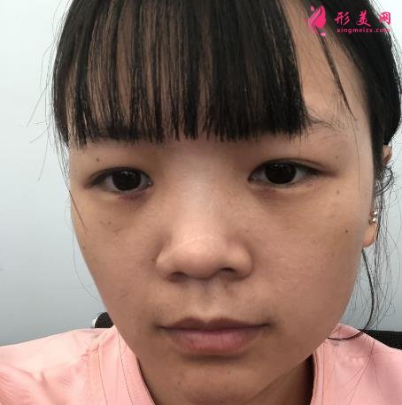 浙江省中医院车菲挂号容易吗?去眼袋多少钱？附案例参考