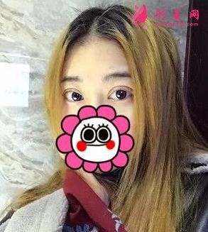 唐山金荣是三甲医院吗?双眼皮案例及价格表一览！