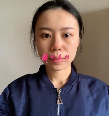 沈阳军区总医院整形科医生名单简介，附隆鼻案例