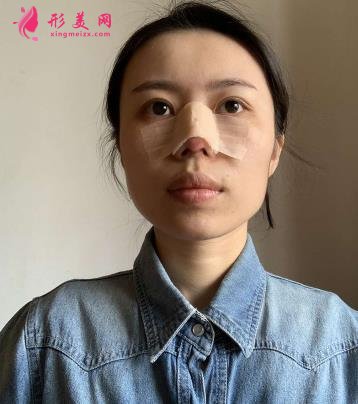 沈阳军区总医院整形科医生名单简介，附隆鼻案例