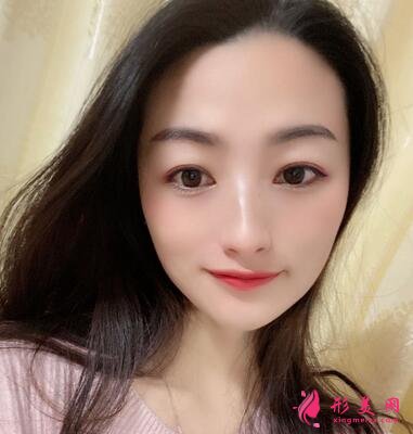 邯郸市第四医院整形科价格表收费|双眼皮案例图赏析~