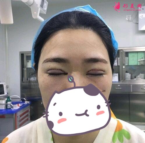 河北友爱医院整形美容科何静做双眼皮案例价格表收费一览