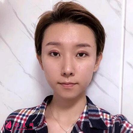 河北省二院整形美容科张卓男双眼皮案例术后恢复效果图展示【实拍】
