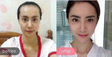 种头发有用吗？种植头发恢复过程真实案例