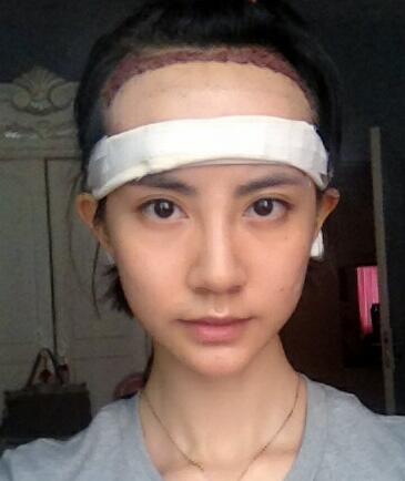 种头发有用吗？种植头发恢复过程真实案例