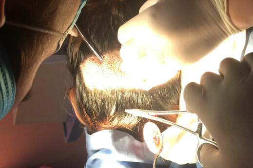 种头发有用吗？种植头发恢复过程真实案例