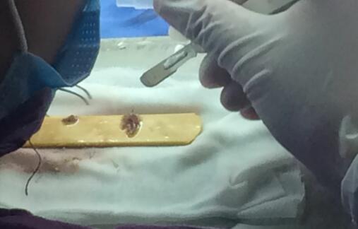 种头发有用吗？种植头发恢复过程真实案例