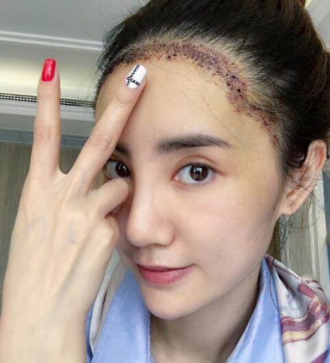 种头发有用吗？种植头发恢复过程真实案例