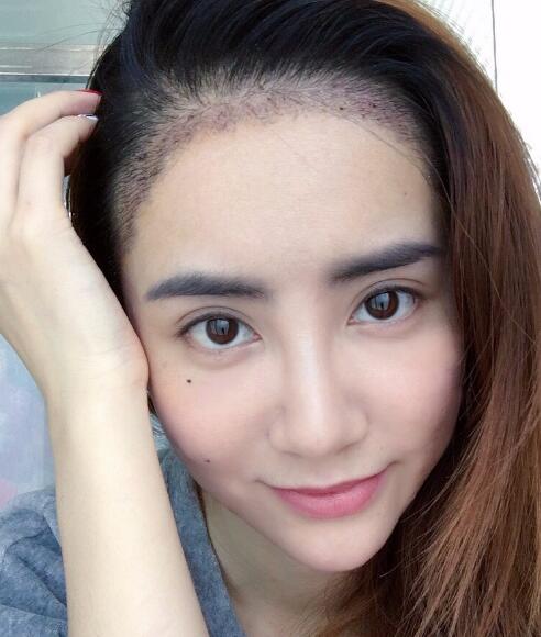 种头发有用吗？种植头发恢复过程真实案例