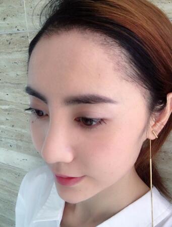 种头发有用吗？种植头发恢复过程真实案例