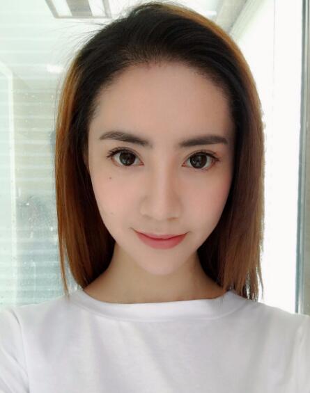 种头发有用吗？种植头发恢复过程真实案例