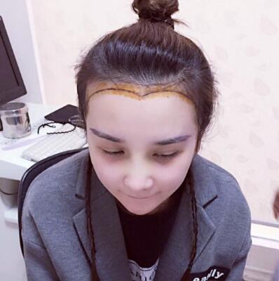 发际线种植效果图和经历分享——南京明基整形医院