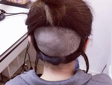 发际线种植效果图和经历分享——南京明基整形医院