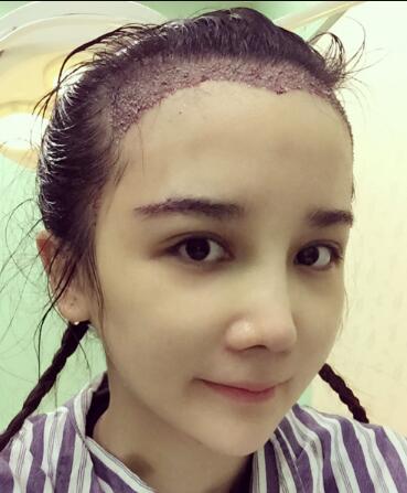 发际线种植效果图和经历分享——南京明基整形医院