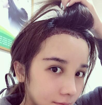 发际线种植效果图和经历分享——南京明基整形医院