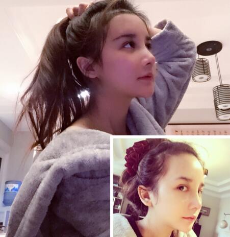 发际线种植效果图和经历分享