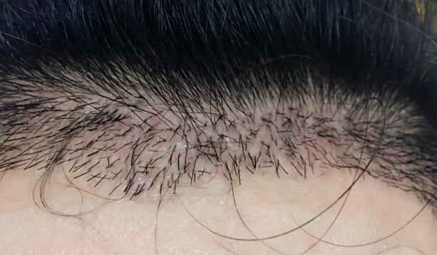 发际线种植效果图和经历分享