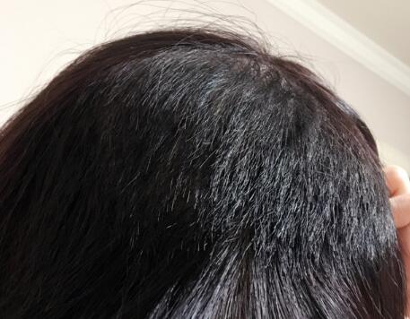 发际线种植效果图和经历