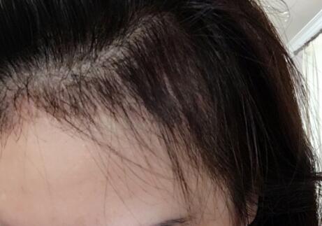 发际线种植效果图和经历