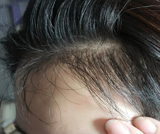 发际线种植效果图和经历分享