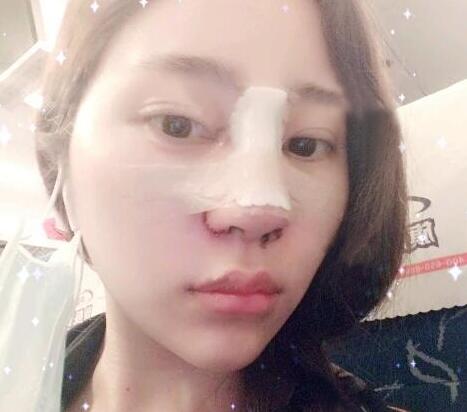 鼻综合整形前后对比图和恢复过程