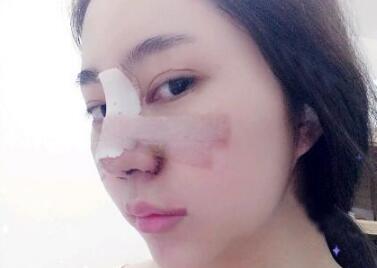 鼻综合整形前后对比图和恢复过程