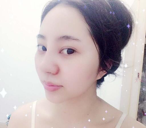 鼻综合整形前后对比图和恢复过程