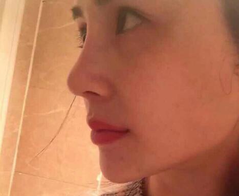 鼻子综合整形前后对比图，恢复过程