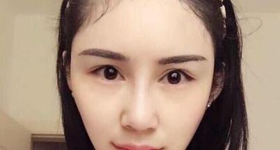 鼻子综合整形前后对比图