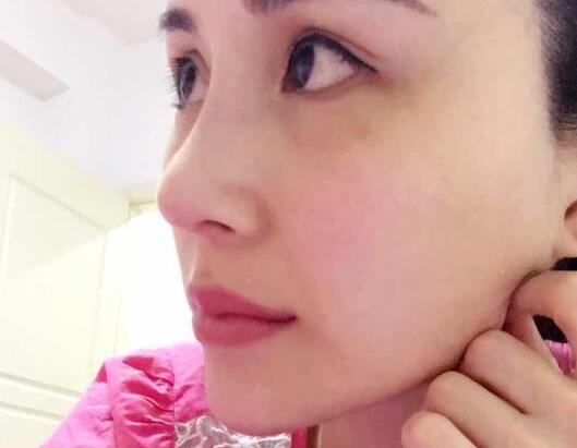 鼻子综合整形前后对比图